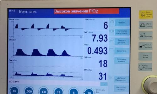 Консультация в црб г. ПОДОЛЬСК (Московская область) нашим нейрореаниматологом больной 36 лет с геморрагическим инсультом для госпитализации в Москву 